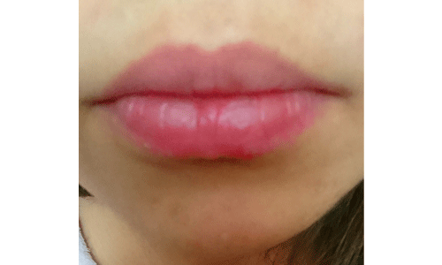 唇の乾燥に悩む２０代女性の唇の写真